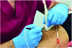 fisioterapeuta hace electrólisis percutanea en Badajoz